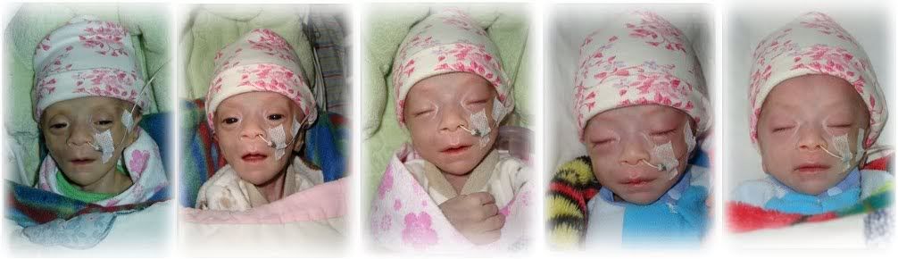 Baby Hong's progress over the week she was cared for by the China Little Flower Mission